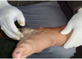 Treated Leg Cancer
